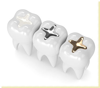 インレー（詰め物）